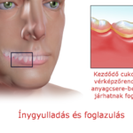 foginygyulladas