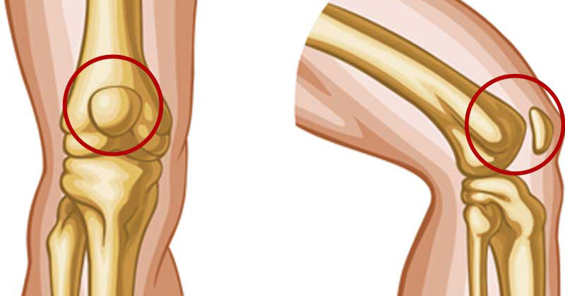 térdfájdalom képek arthrosis ozokeritis kezelés